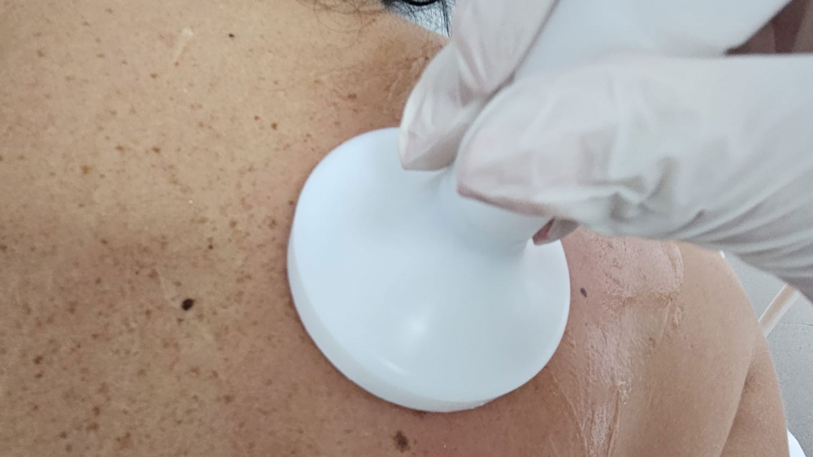 Terapia dermomassager cu vacuum