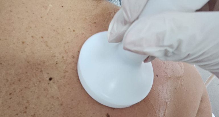 Terapia dermomassager cu vacuum