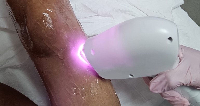 Tratamentul cu laser